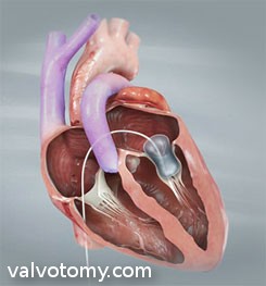 ballooning-mitral-valve-syndrome-20634_com_90.jpg